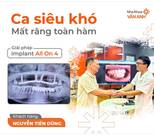 MẤT RĂNG TOÀN HÀM  CA SIÊU KHÓ ĐÃ CÓ NHA KHOA VÂN ANH LO