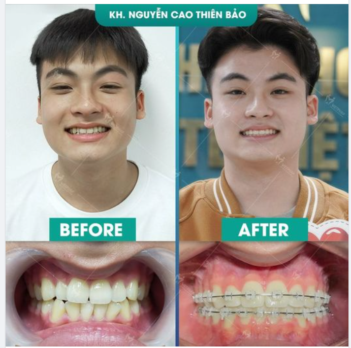 THIẾT KẾ NỤ CƯỜI TỪ VIỆC NIỀNG RĂNG