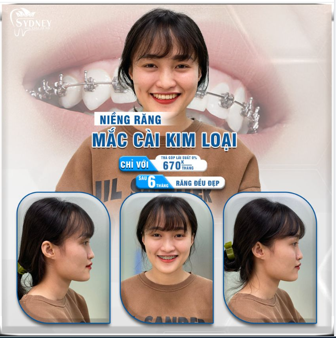 Niềng răng có thay đổi góc nghiêng không?