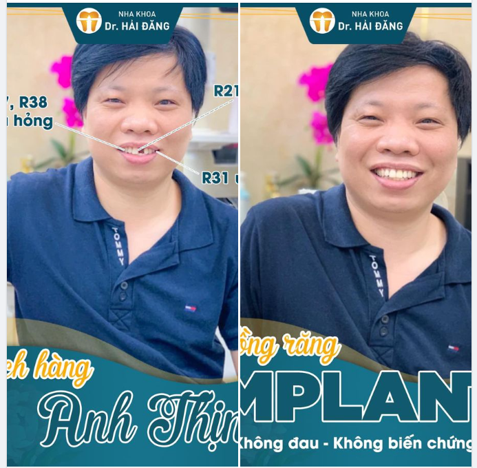 Việc mất răng sẽ ảnh hưởng đến rất nhiều về vấn đề ăn nhai, răng bị xô lệch, sai khớp cắn, tiêu xương hàm.