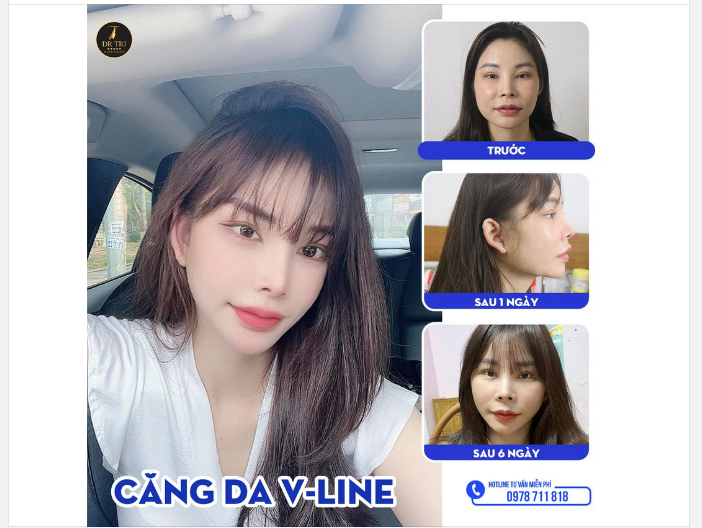 TRẺ HÓA GƯƠNG MẶT THÊM 10 TUỔI BẰNG CĂNG DA VLINE