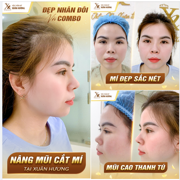ĐẸP NHÂN ĐÔI VỚI COMBO NÂNG MŨI CẮT MÍ TẠI XUÂN HƯƠNG