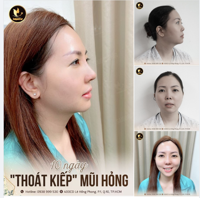 10 NGÀY “THOÁT KIẾP” MŨI HỎNG