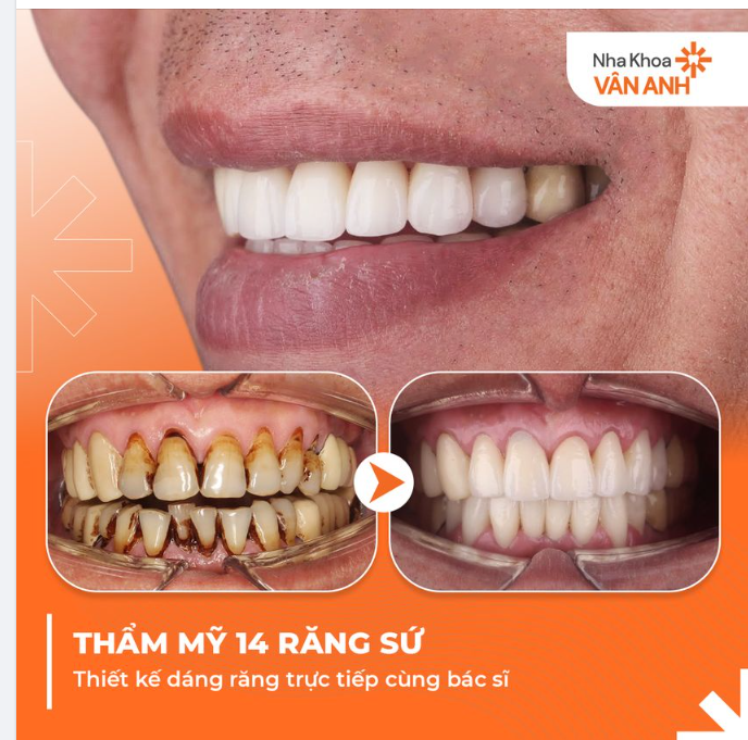 THẨM MỸ 14 RĂNG SỨ  KHẮC PHỤC HOÀN TOÀN RĂNG Ố VÀNG - SỨT MẺ