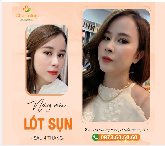 Mũi em nhìn thẳng nhìn nghiêng. Nhìn đâu cũng thấy nét duyên ngút ngàn