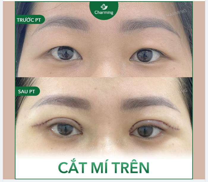 Phải làm gì khi đôi mắt có 2 mí nhưng lại không lộ rõ đây? Đừng lo vì giờ đây đã có phương pháp cắt mí trên.