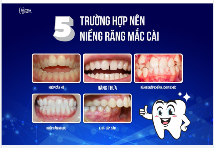 5 TRƯỜNG HỢP NÊN NIỀNG RĂNG MẮC CÀI