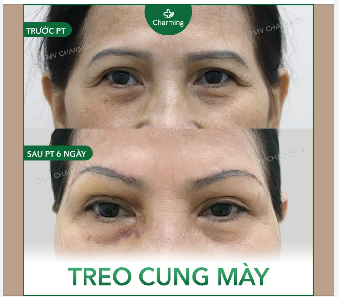 Đối với những ai ở lứa tuổi trung niên thì cung chân mày chảy xệ là một trong những tình trạng khiến nhiều người đau đầu.