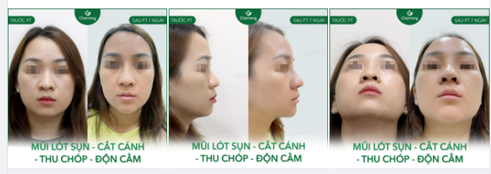 COMBO NÂNG MŨI + ĐỘN CẰM VẠN NGƯỜI MÊ