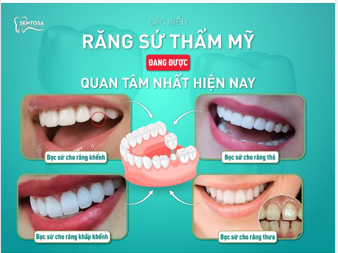 CÁC KIỂU RĂNG SỨ THẨM MỸ ĐANG ĐƯỢC QUAN TÂM NHẤT HIỆN NAY