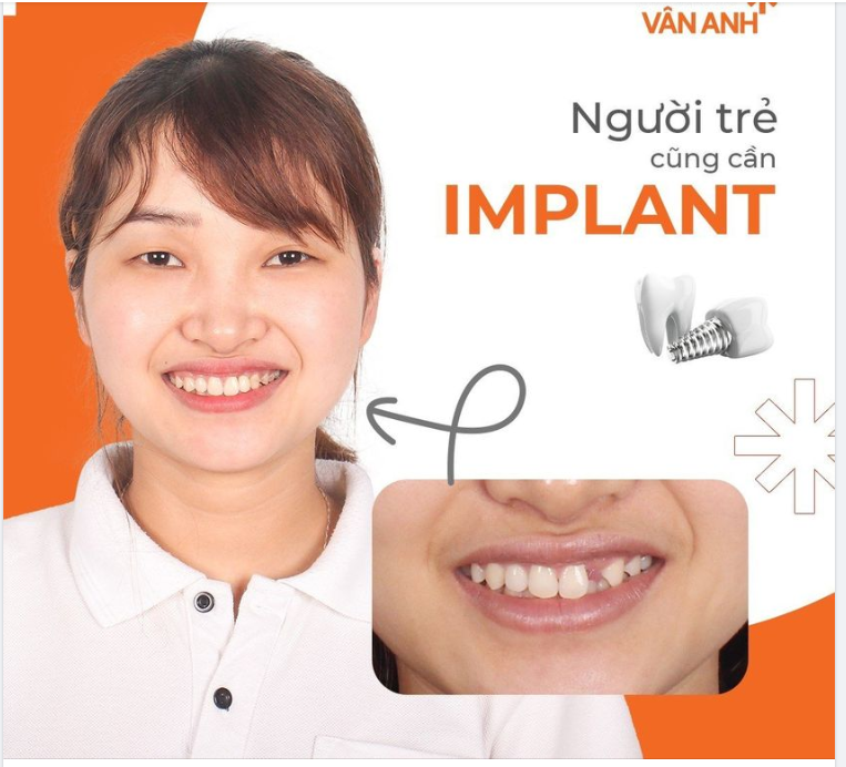 CÒN TRẺ MẤT RĂNG KHÔNG SAO? HOÀN TOÀN SAI LẦM