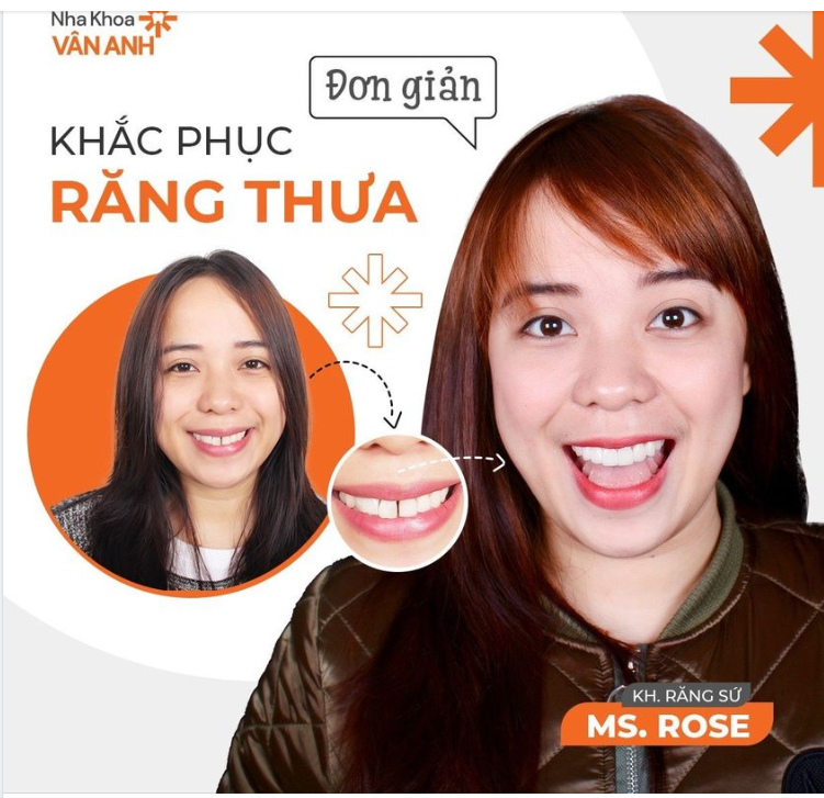 HẾT NGAY RĂNG THƯA VỚI BỌC SỨ