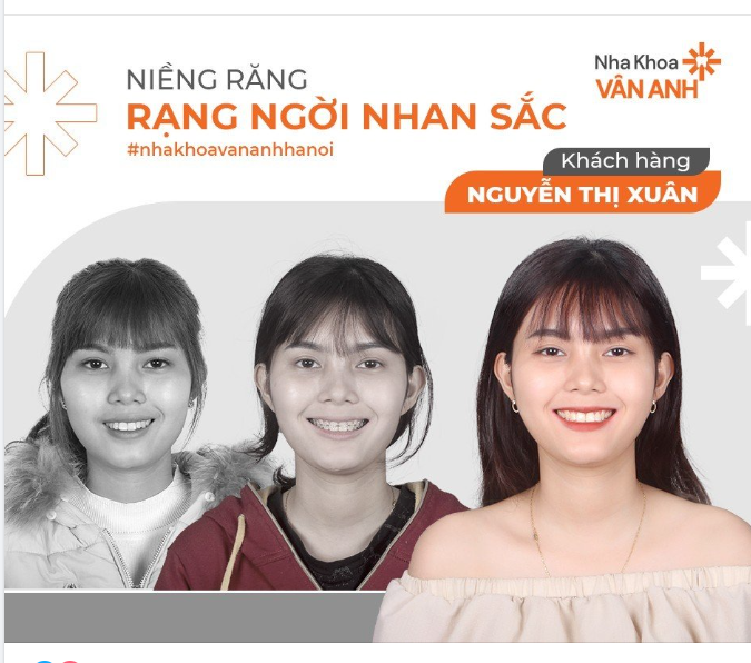 NIỀNG RĂNG MANG ĐẾN NHIỀU THAY ĐỔI HƠN BẠN NGHĨ!