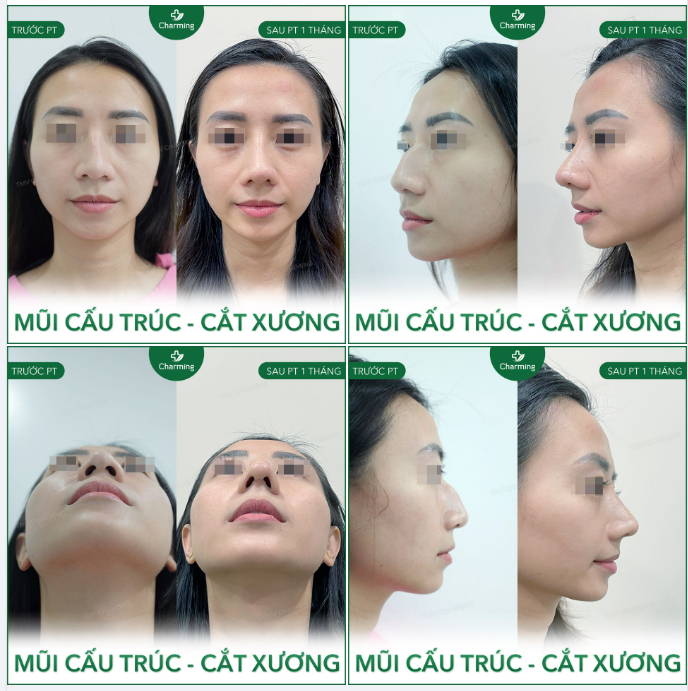 Một sự thay đổi ngoạn mục đến từ nàng khách thực hiện nâng mũi cấu trúc sụn sườn và cắt xương tại Charming