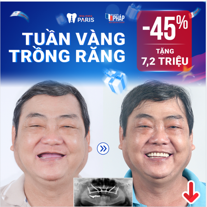 ĐẠI LỄ TRỒNG RĂNG GIÁ SỐC