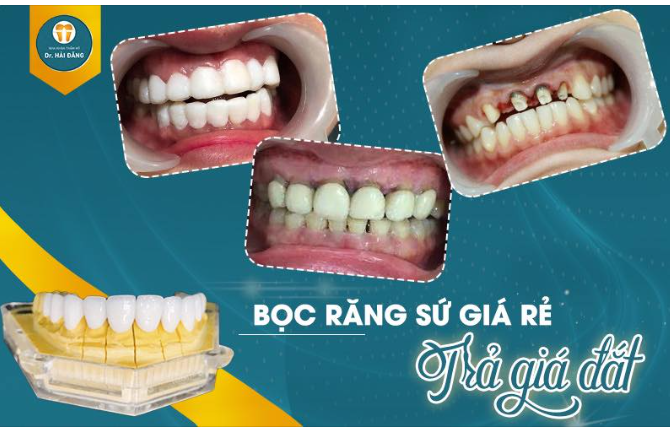 Thường khách hàng tìm đến những địa chỉ Nha Khoa uy tín và bác sĩ có tay nghề chuyên môn giỏi để thực hiện.