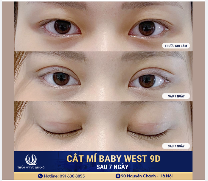 Khoe nhẹ cả nhà ca cắt mí siêu đẹp sau 7 ngày. Nếp mí sâu, sắc nét, đường cắt mí mảnh, mà lại không hề sưng đau hay phải nghỉ dưỡng.