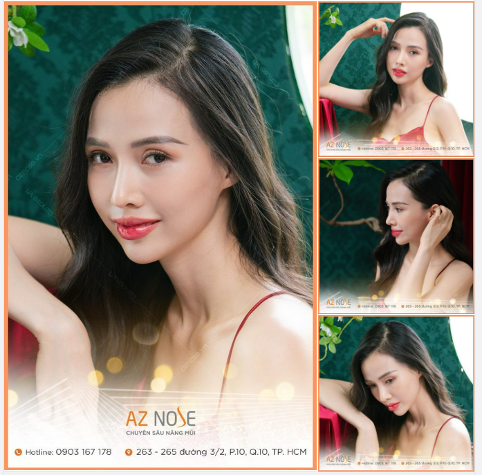 Dáng mũi 5 năm tại AZ NOSE