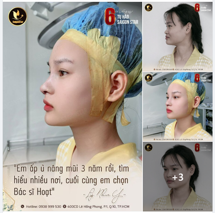 “Em ấp ủ nâng mũi 3 năm rồi, tìm hiểu nhiều nơi, cuối cùng em chọn Bác sĩ Hoạt” – Như Ý chia sẻ.