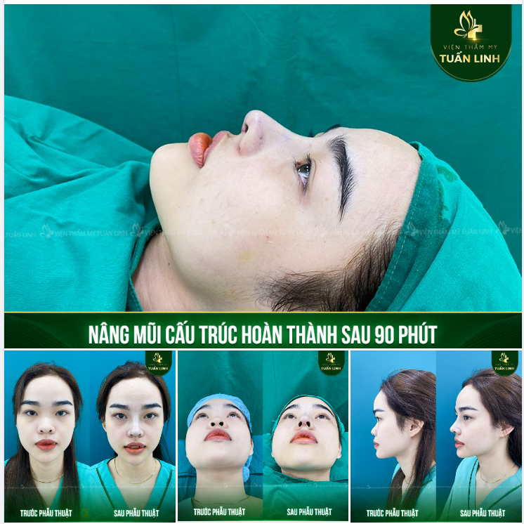 NÂNG MŨI CẤU TRÚC - HOÀN THÀNH SAU 90 PHÚT!