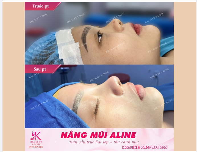 NÂNG MŨI ALINE - VẸN TOÀN TÀI SẮC