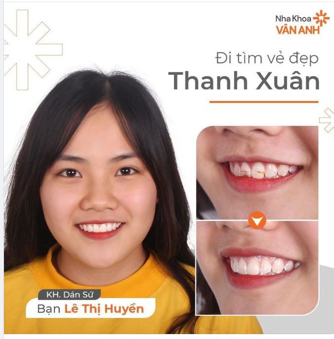 DÁN SỨ KHẮC PHỤC THIỂU SẢN MEN RĂNG