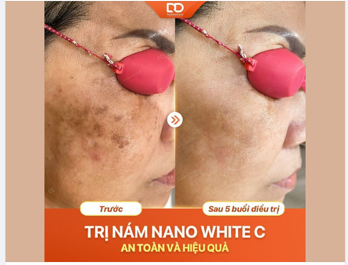 TRỊ NÁM NANO WHITE C AN TOÀN - HIỆU QUẢ