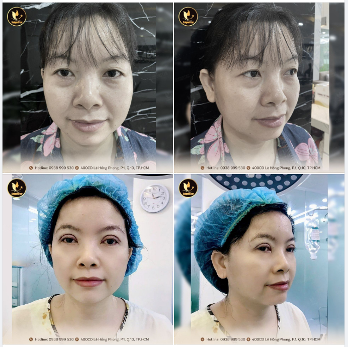 Cuối tuần thả nhẹ chiếc ảnh xinh đẹp của chị khách trước và sau 30 phút tạo hình nếp mí.