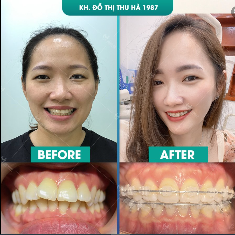 ĐỘ TUỔI NÀO THÍCH HỢP ĐỂ NIỀNG RĂNG?
