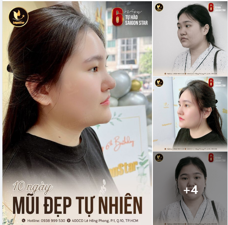 10 NGÀY MŨI ĐẸP TỰ NHIÊN