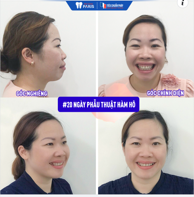 CHỈNH HÀM MẶT BÂY GIỜ CÓ KỊP ĐI CHƠI 30/4 KHÔNG?