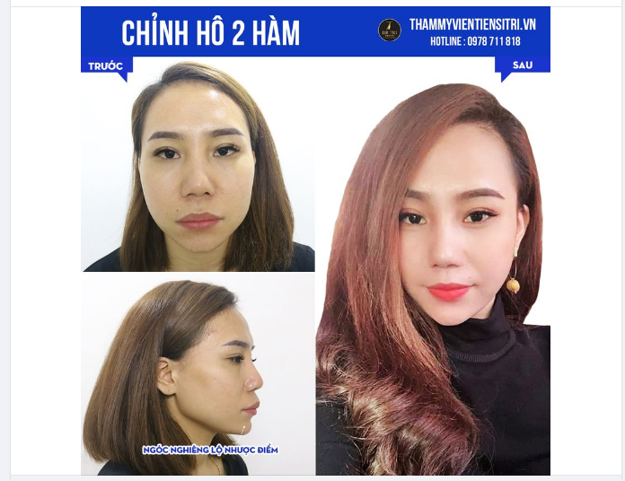 MỘT CA CHỈNH HÔ 2 HÀM THÀNH CÔNG SẼ NHƯ THẾ NÀO?
