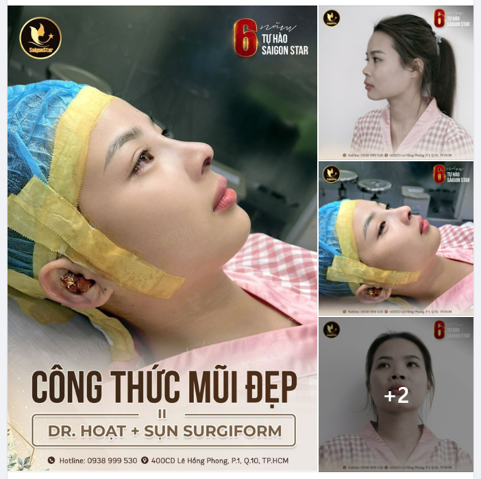 CÔNG THỨC MŨI ĐẸP = DR. HOẠT + SỤN SURGIFORM