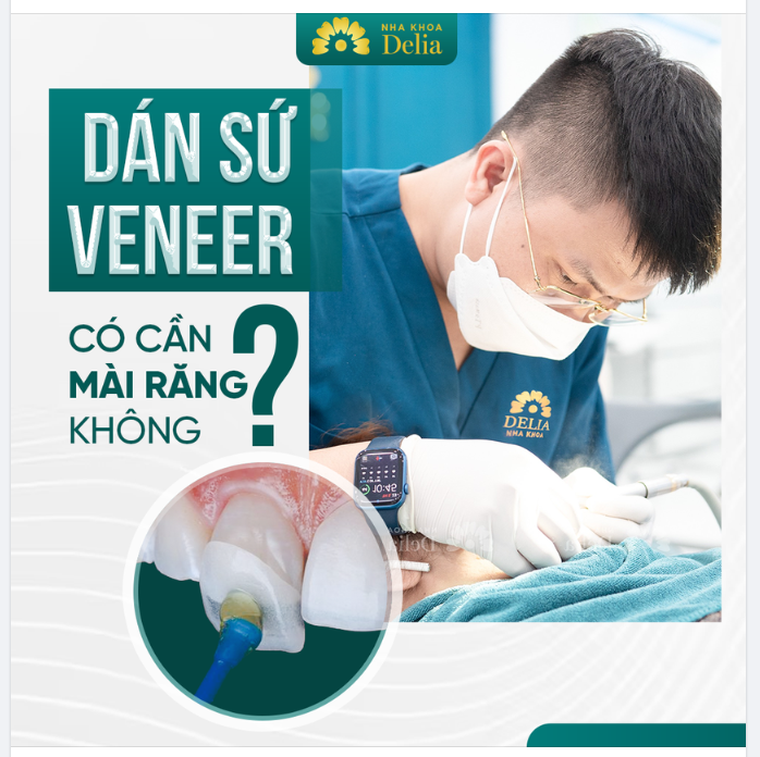 DÁN SỨ VENEER KHÔNG MÀI NHỎ - BẢO TỒN RĂNG GỐC