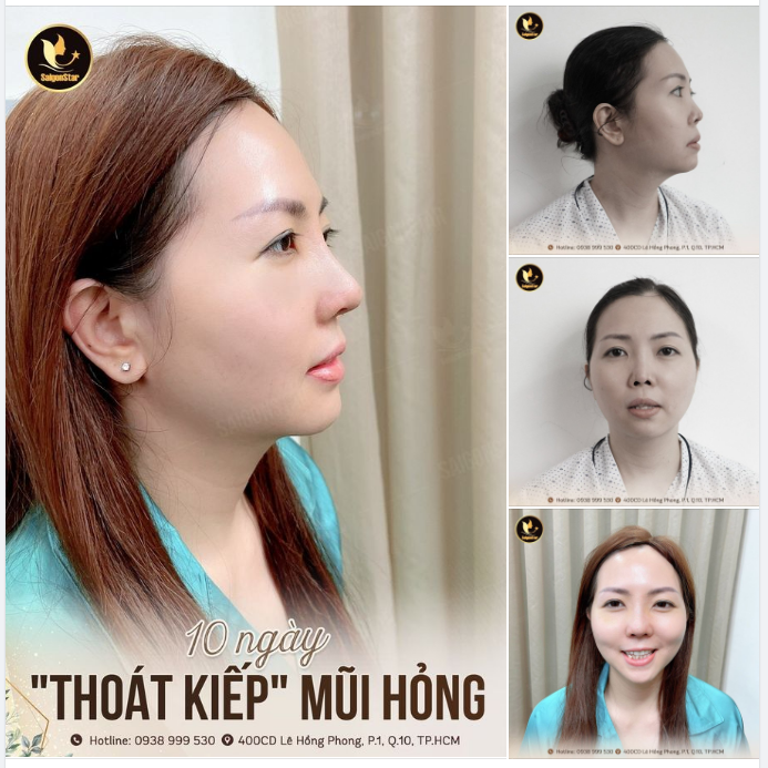10 NGÀY “THOÁT KIẾP” MŨI HỎNG