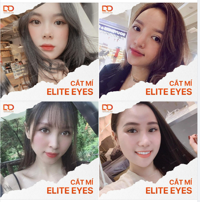 CẮT MÍ ELITE EYES: 7 NGÀY MÍ ĐẸP TỰ NHIÊN