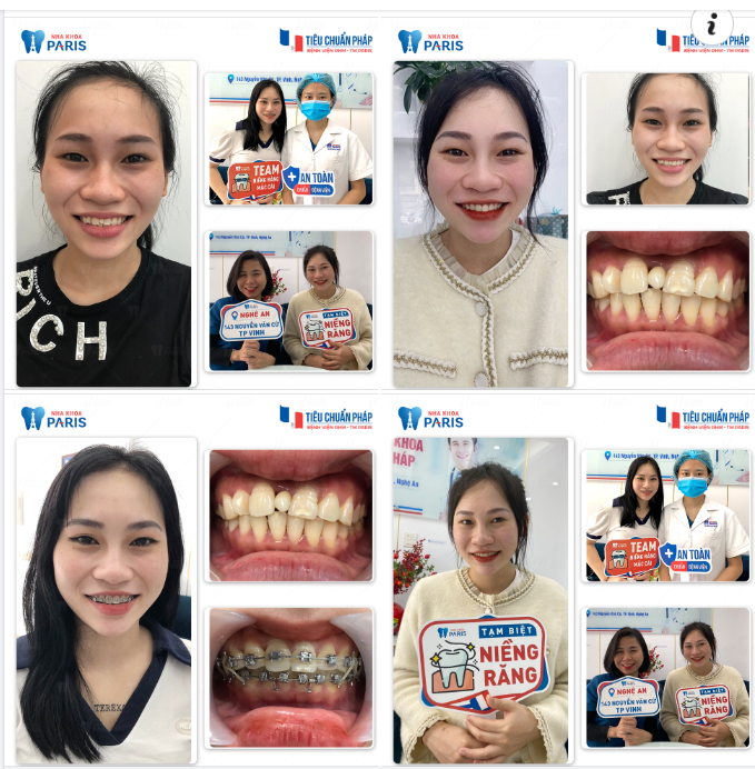 NIỀNG RĂNG HIỆU QUẢ CHUẨN BỆNH VIỆN
