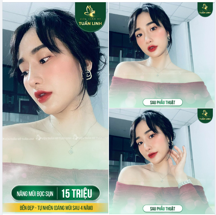 Nâng mũi bọc sụn - An toàn - Bền đẹp - Tự nhiên - Giá chỉ 15TR Trọn gói không phát sinh chi phí.