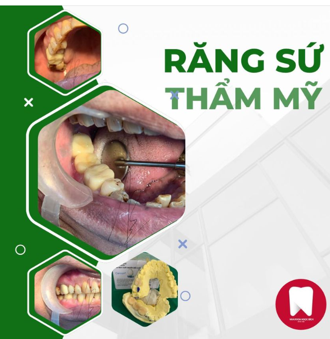 ĐỊA CHỈ LÀM RĂNG SỨ UY TÍN ĐƯỢC KHÁCH HÀNG TIN YÊU