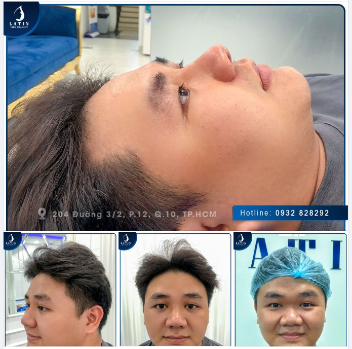 Nâng mũi giúp bạn thay đổi như thế nào? Hóa HOTBOY sau khi nâng mũi tại Latin