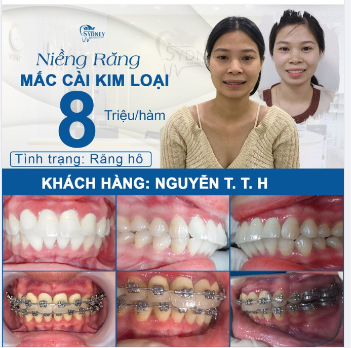 Người trưởng thành niềng răng hô có hiệu quả không?