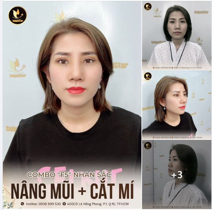 COMBO “F5” NHAN SẮC  NÂNG MŨI + CẮT MÍ MẮT