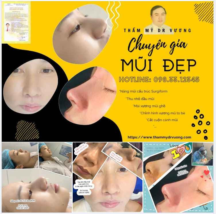 Nâng mũi chỉnh sửa mũi đẹp đến từng chi tiết với Dr Vương:
