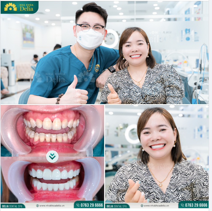 Cùng ngắm nhìn nụ cười rạng rỡ của chị Ngân sau thẩm mỹ răng sứ tại nha khoa Delia.