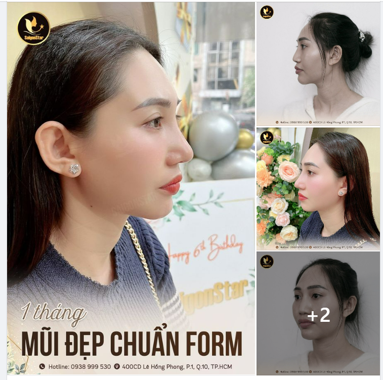 1 THÁNG MŨI ĐẸP CHUẨN FORM