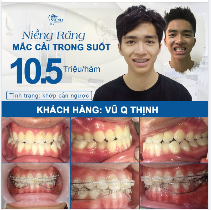 Khắc phục khớp cắn ngược bằng mắc cài trong suốt chỉ 10,5tr/hàm