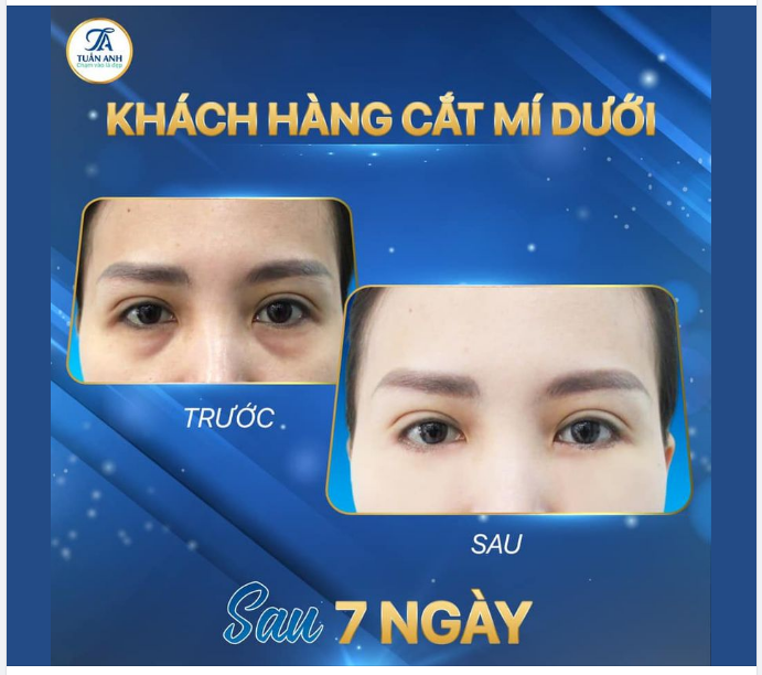 Cắt mí dưới công nghệ EyesLift độc quyền tại Thẩm mỹ Tuấn Anh