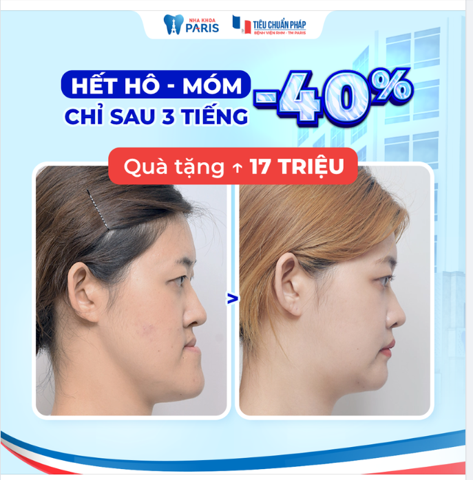 Chỉnh hàm hô móm đang giảm 40% tại Bệnh viện RHM Thẩm mỹ Paris