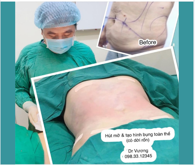 Xử trí bụng siêu bự với Dr Vương