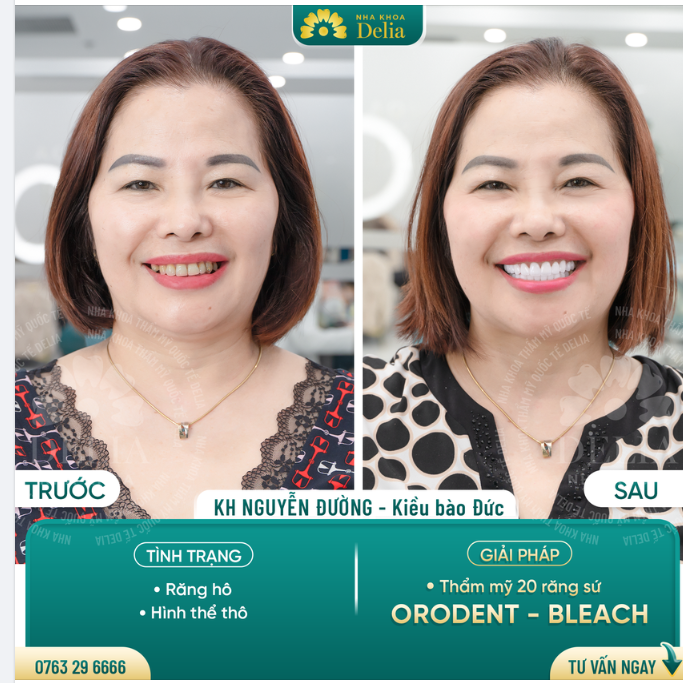 Chỉ mất 2 ngày về nước - Khắc phục răng hô cho kiều bào Đức